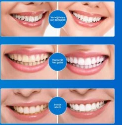 B-care Tanden Bleekpen - Teeth Whitening Pen - Tanden Bleker - Wittere Tanden - Teeth Whitening Strips - Professioneel Resultaat - Tandsteen Verwijderaar - Zonder Peroxide - Tandenbleekset - Tanden Bleken -Mondelinge Benodigdheden Winkel 1170x1200 5