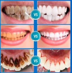 B-care Tanden Bleker – Wittere Tanden – Teeth Whitening Strips – Professioneel Resultaat - Tandsteen Verwijderaar - Zonder Peroxide - Tandenbleekset - Tanden Bleken -Mondelinge Benodigdheden Winkel 1181x1200 5