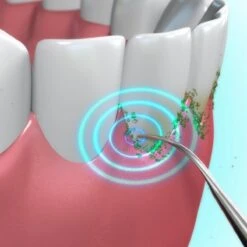 Toppers Van TV - Sonic Tandsteenverwijderaar - Tandplakverwijderaar -Mondelinge Benodigdheden Winkel 1200x1200 1007