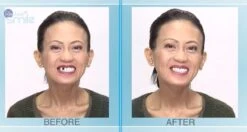 Tand Afgebroken Reparatie Kit InstantSmile Gebit (goedkope Kunstgebit) - Multi Shade -Mondelinge Benodigdheden Winkel 1200x639