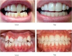 Edoir Rechte Tanden Beugel - Retainer Voor Rechte Tanden - Rechte Tanden Bitje -Mondelinge Benodigdheden Winkel 1200x929