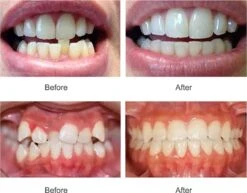 SAMA Direct™ Rechte Tanden Zonder Beugel - Orthodontische Bitjes - Rechte Tanden Bitje - Beugel - Knarsbitje - Nachtbeugel - Knarsen Bitje - Rechte Tanden - Witte Tanden -Mondelinge Benodigdheden Winkel 1200x938 2